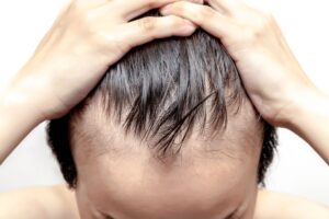 7 cách làm tóc mọc ở trán hiệu quả tránh tình trạng hói đầu