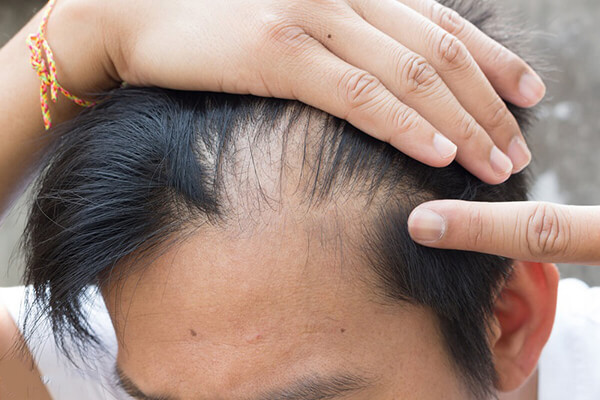 Nguyên nhân gây rụng tóc ở vùng trán